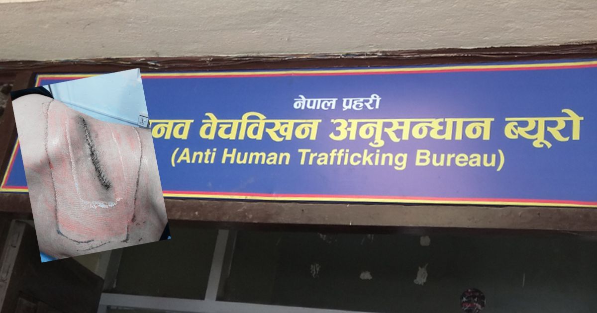 भारतमा काम लगाइदिने बहानामा जब झिकियो नेपाली युवकको मिर्गौला…