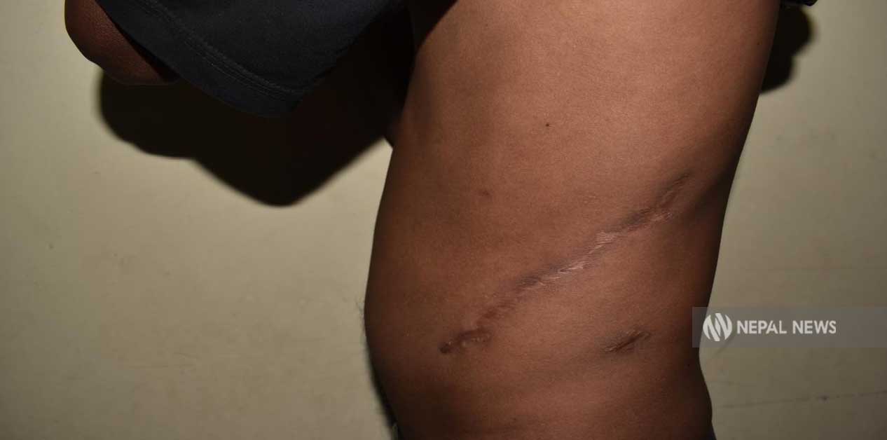 ब्याङ्‌लोर पुर्‍याएर झिकियो दलित दम्पतीको मिर्गौला