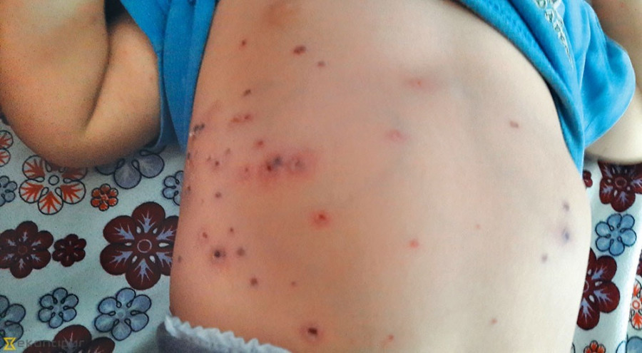 बागलुङमा डेङ्गुभन्दा स्क्रब टाइफसका बिरामी धेरै