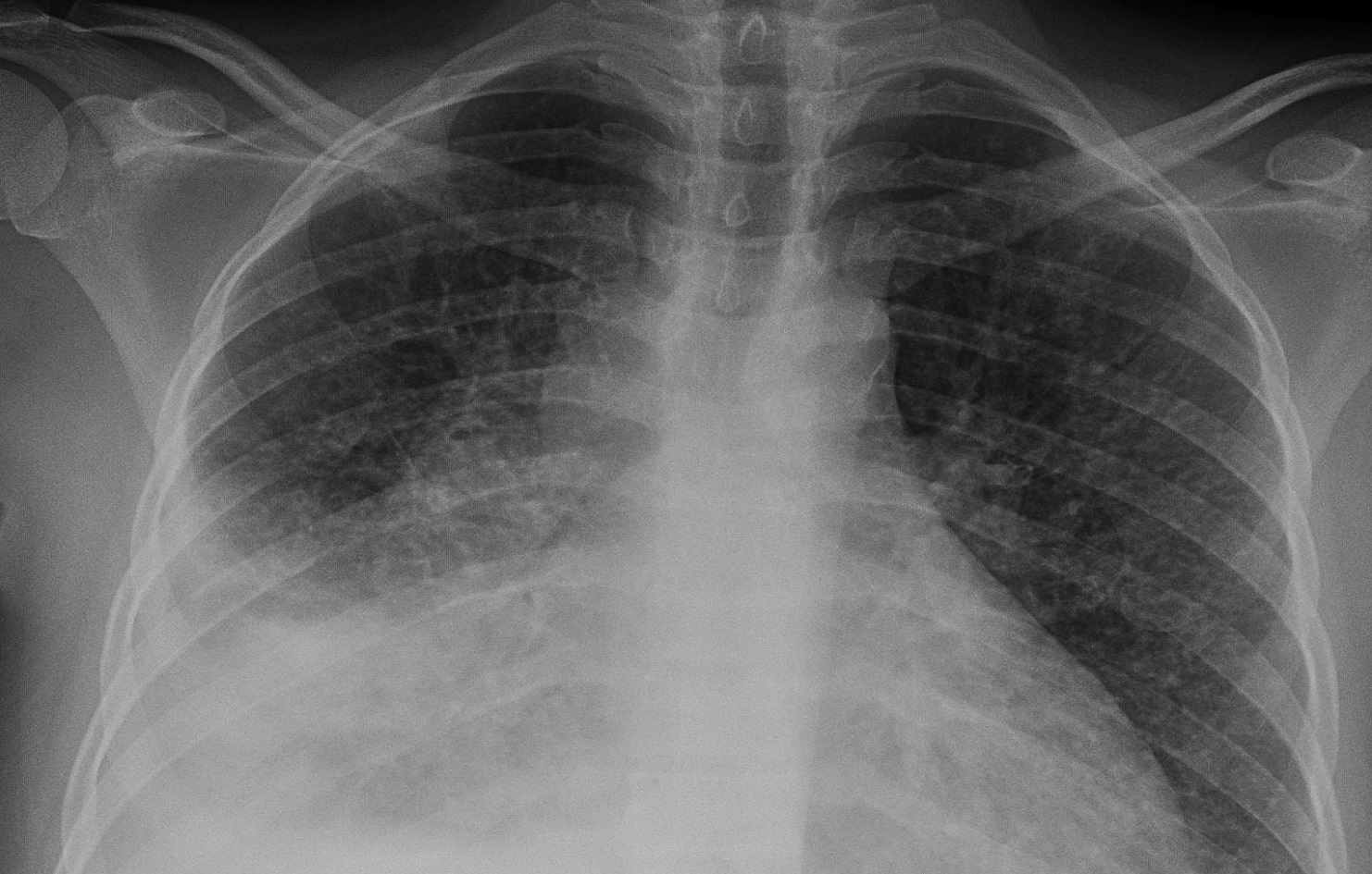 एक सय जनामा क्षयरोग सङ्क्रमण