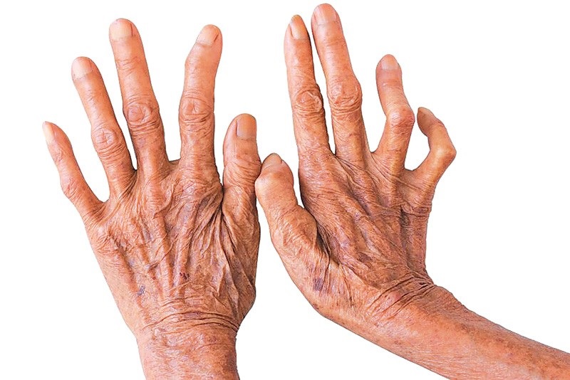 पाल्पामा छ महिनामा थपिए सात कुष्ठरोगी