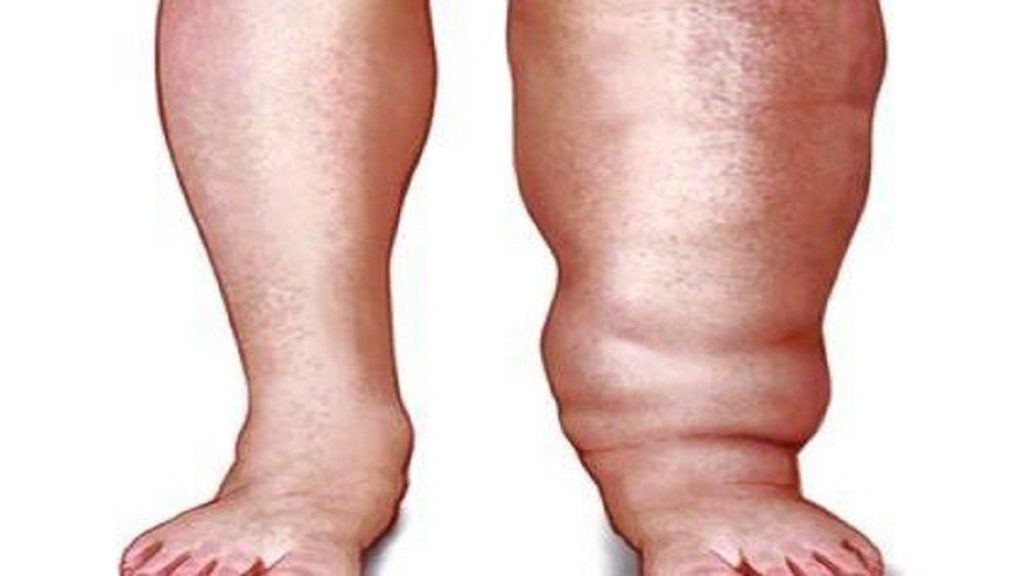 हात्तीपाइलेविरुद्धको दशदिने औषधि सेवन अभियान सुरु